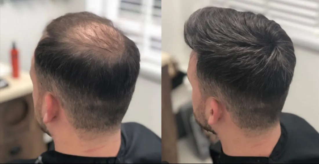 Avant après prothèse capillaire : couronne dégarnie à volume complet, vue de profil